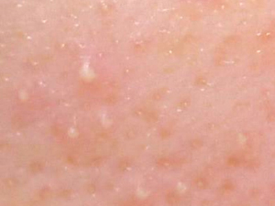 白ニキビの原因って Blanche